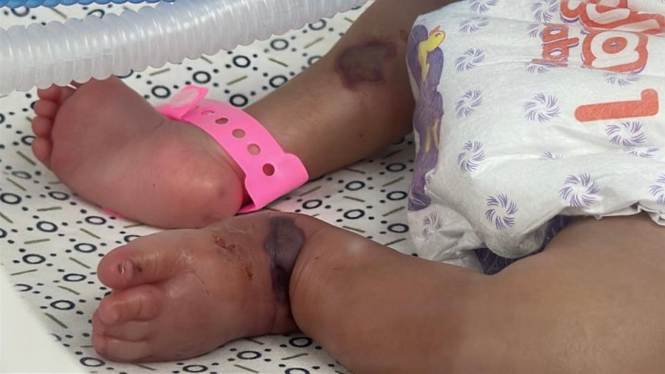 The legs of an infant covered in bruises inside a hospital incubator.